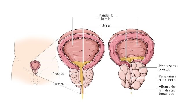 benigna hiperplazija prostate simptomi)