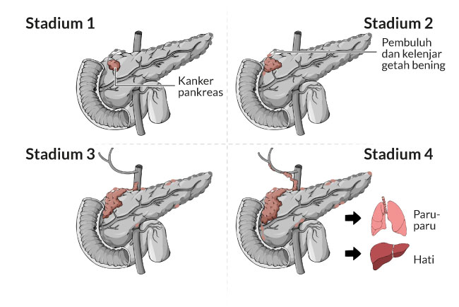 kanker pankreas, gejala, penyebab, cara mencegah, cara mengobati, alodokter