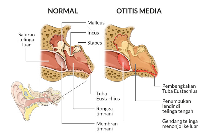 Otitis Media Gejala Penyebab Dan Mengobati Alodokter