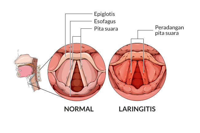 Laringitis Gejala Penyebab Dan Mengobati Alodokter