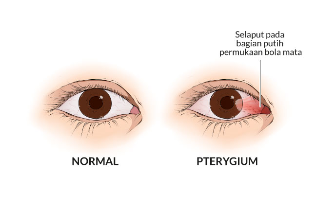 Pterygium Gejala Penyebab Dan Mengobati Alodokter