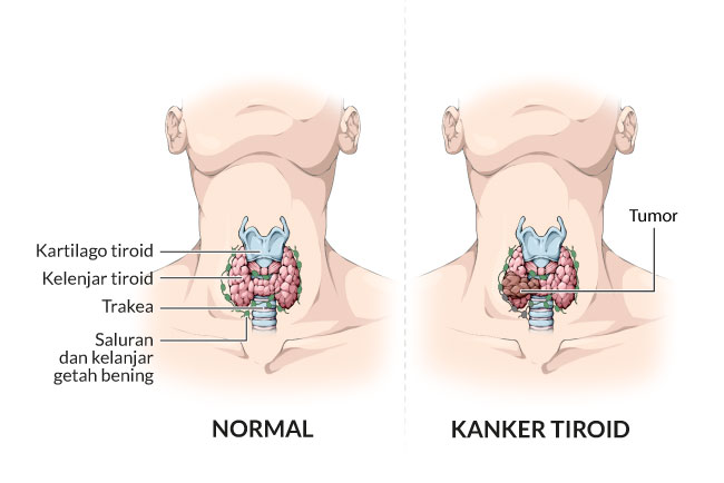 kanker tiroid, gejala, penyebab, cara mencegah, cara mengobati, alodokter
