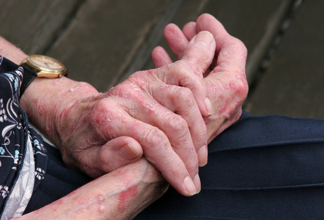 Extreme,Psoriasis,On,The,Hands,Of,An,Elderly,Female.