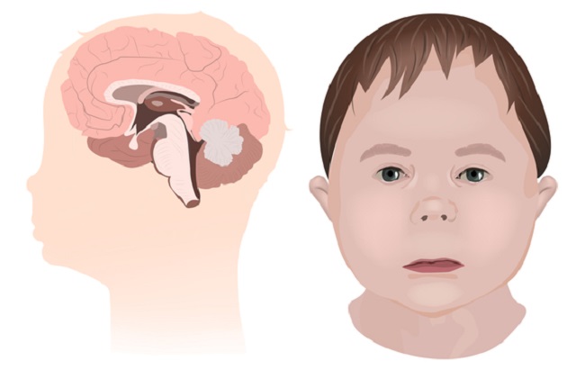 Fetal Alcohol Syndrome Cartoon