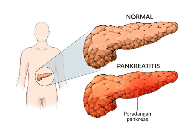 pankreatitis, gejala, penyebab, cara mencegah, cara mengobati, alodokter