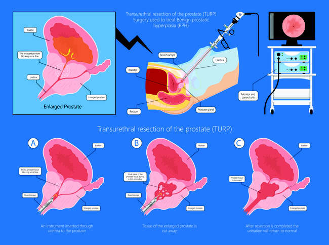 prostata operatie laser)