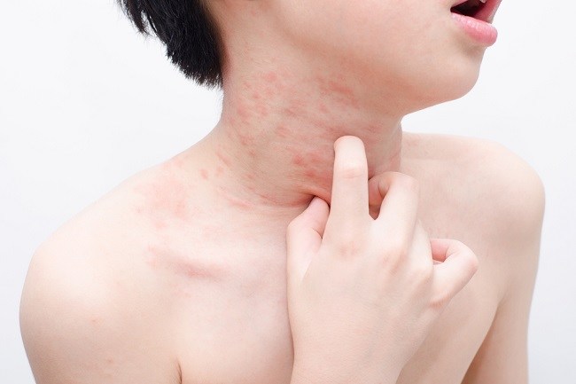 Impetigo pada Anak, Ini Penyebab dan Cara Mengatasinya - Alodokter