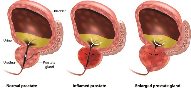 prostatita cu flux lent)