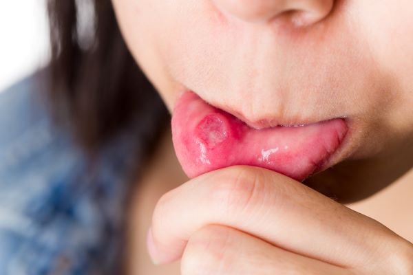 Mouth Ulcers