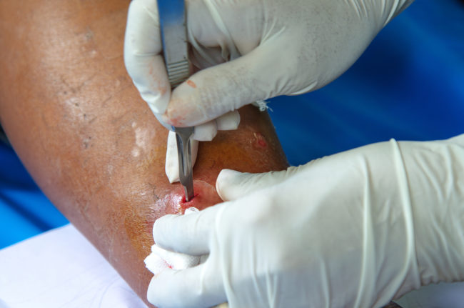 Kista Ateroma, Kenali Penyebab dan Cara Menanganinya - Alodokter