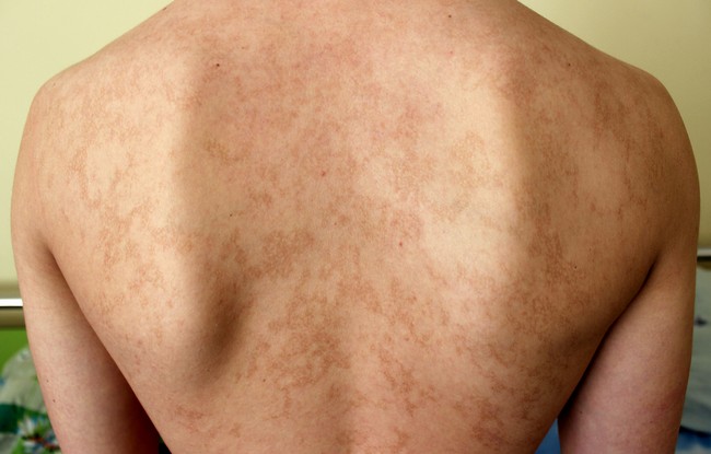 Livedo Reticularis