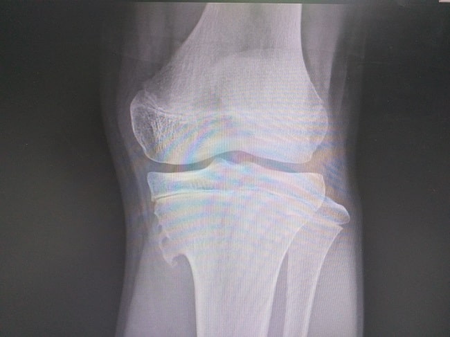 Diagnosis Osteochondroma Alomedika