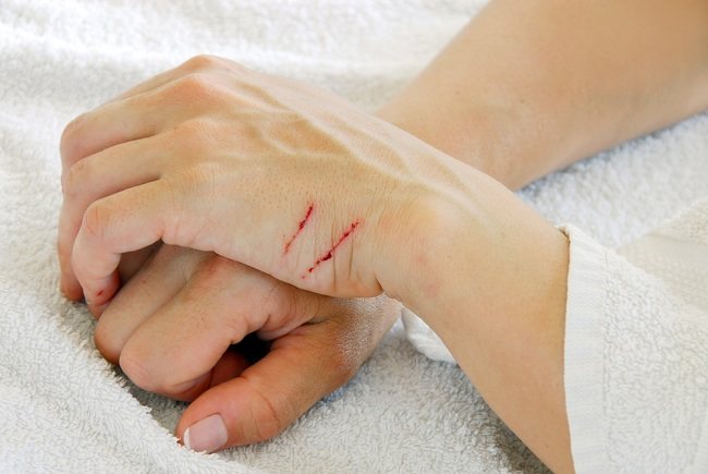 Cara menghilangkan bekas luka di kaki yang sudah lama dan menghitam