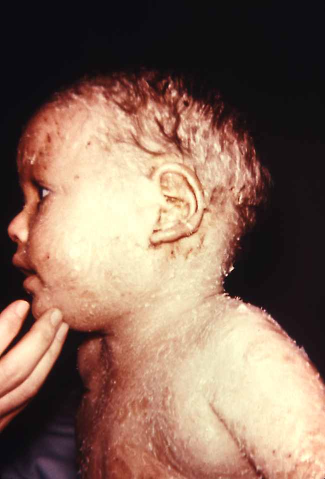 Dermatitis Seboroik anak. Sumber: S Lindsley, PHIL CDC, 1973.