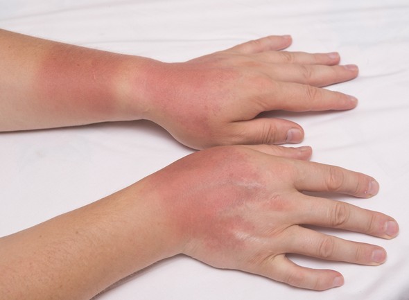 ผิวไหม้แดด (Sunburn) - อาการ, สาเหตุ, การรักษา - Pobpad ผิวไหม้แดด (Sunburn) - อาการ, สาเหตุ, การรักษา - Pobpad