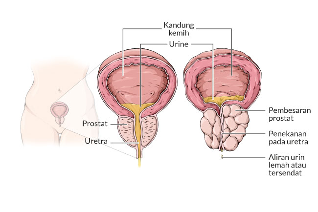 Gambar Patofisiologi Benign Prostatic Hyperplasia