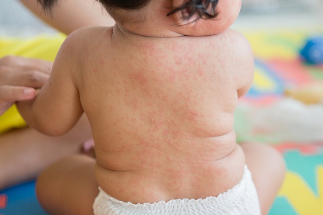 Exanthem,Subitum,,Roseola,Infantum,,Sixth,Disease,,Seudo,Rubella,Baby,Sick