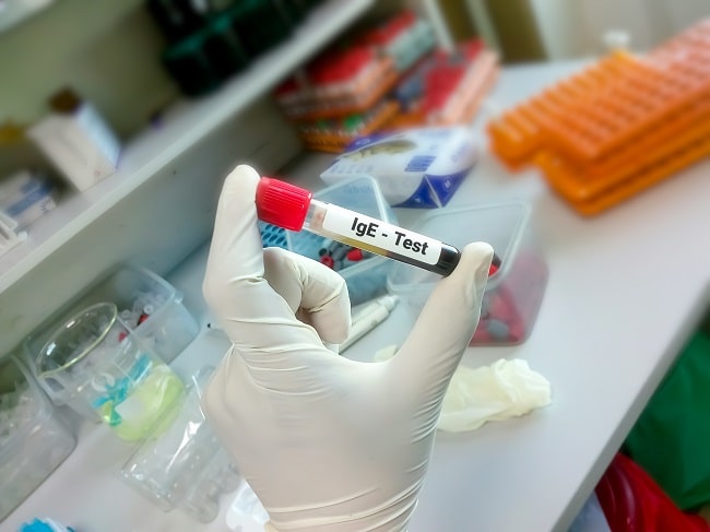 Serum Specific IgE Sebagai Pemeriksaan Alergi Alomedika serum-specific-ige-sebagai-pemeriksaan-alergi-alomedika