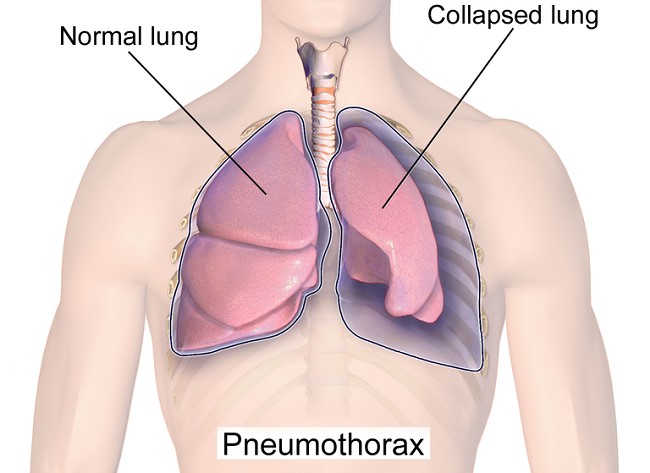 Pneumothorax Image