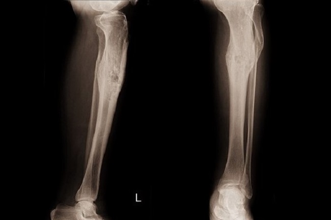 Osteomielitis Gejala Penyebab Dan Mengobati Alodokter