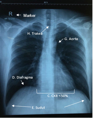 Rontgen toraks. Sumber: dr. Immanuella, 2018.
