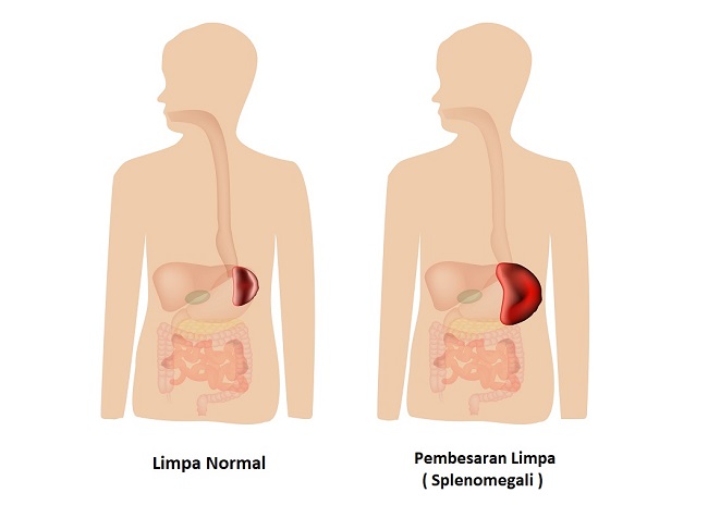 Splenomegali Patofisiologi Diagnosis Penatalaksanaan Alomedika