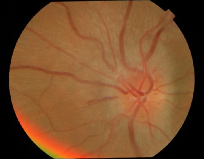 Epidemiologi Neuritis Optik - Alomedika