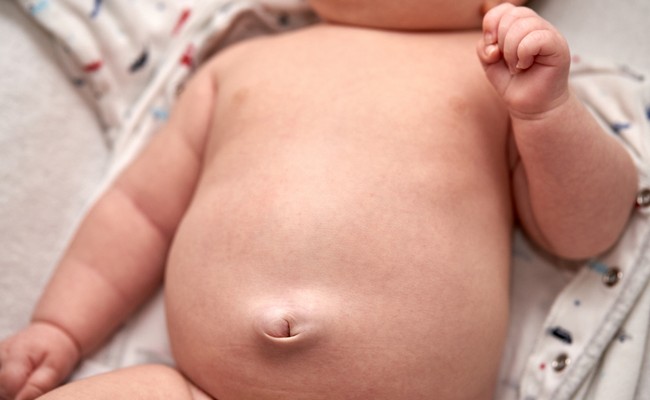Hernias in Babies