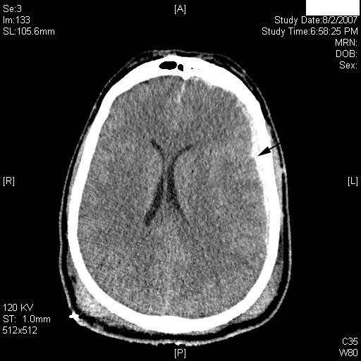 CT Scan pada cedera otak traumatik. Sumber: anonim, Openi, 2009.