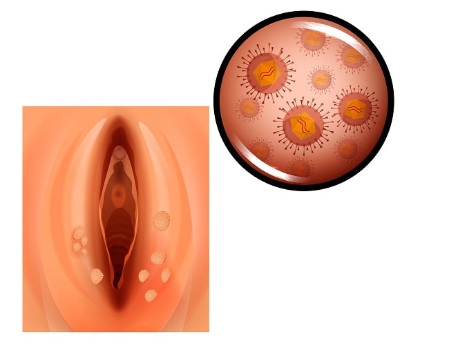 virusul papiloma din organism parazitoza la om