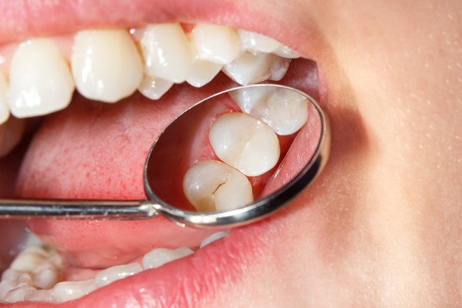 Dental,Treatment,In,The,Dental,Clinic.,Rotten,Carious,Tooth,Close-up