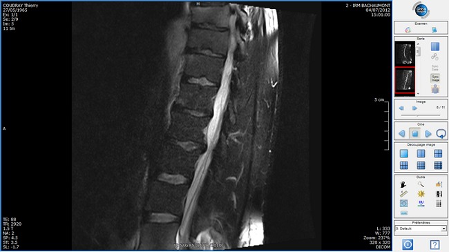 Gambaran MRI herniasi diskusi L4-L5. Sumber: anonim, Wikimedia commons, 2012.