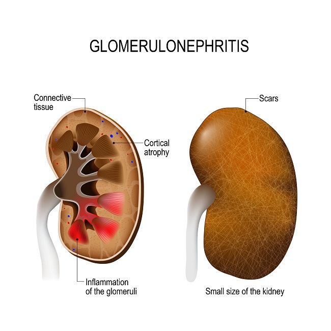 Infeksi Kuman Pada Glomerulus Menimbulkan Penyakit Glomerulonefritis - patofisiologi, diagnosis, penatalaksanaan - Alomedika