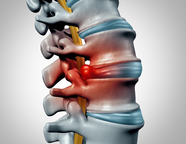 disc herniation