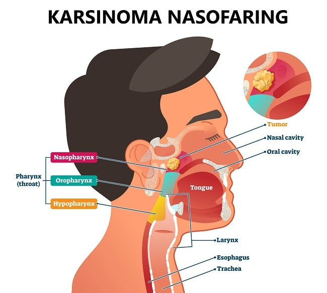 Gambar 1. Diagram Kanker Nasofaring (Sumber : Cancer Research UK, Wikimedia Commons, 2014)