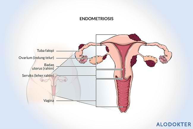 Endometriosis fotos reales