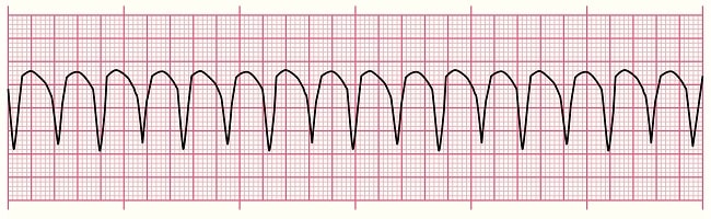 Diagnosis Ventricular Tachycardia Alomedika