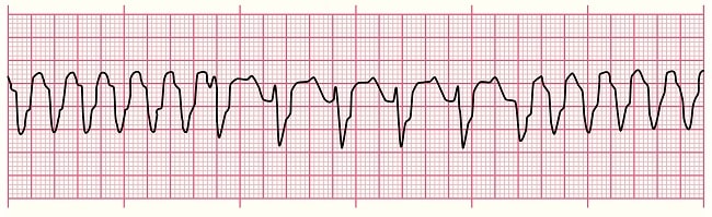 Diagnosis Ventricular Tachycardia Alomedika