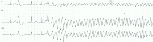 Diagnosis Ventricular Tachycardia Alomedika