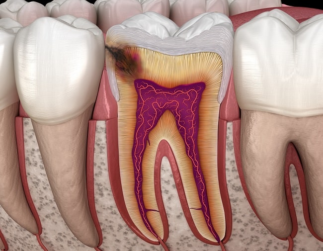 Diagnosis Pulpitis Alomedika