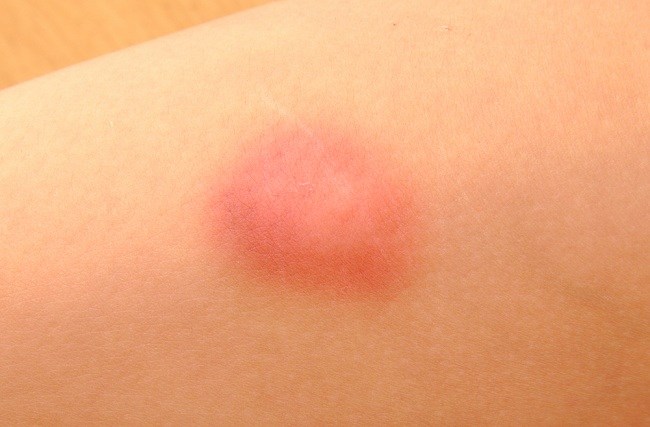 Pertolongan Pertama pada Luka Memar - Alodokter