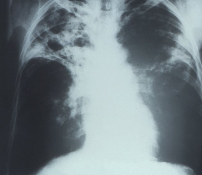 https://res.cloudinary.com/dk0z4ums3/image/upload/v1643188396/attached_image/penyakit/pulmonologi/tuberkulosis-paru/diagnosis.jpg