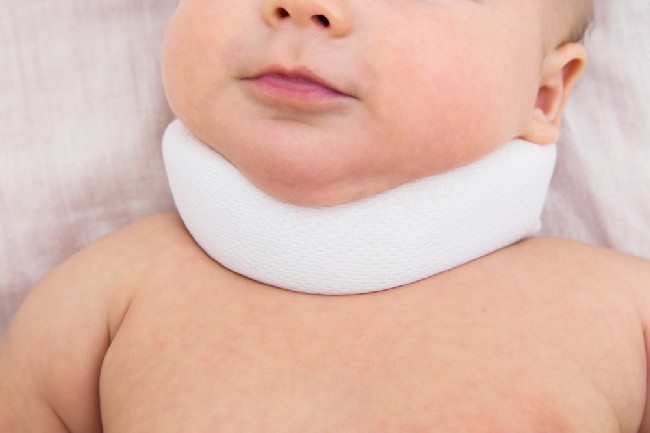 ภาวะคอเอียง (Torticollis)