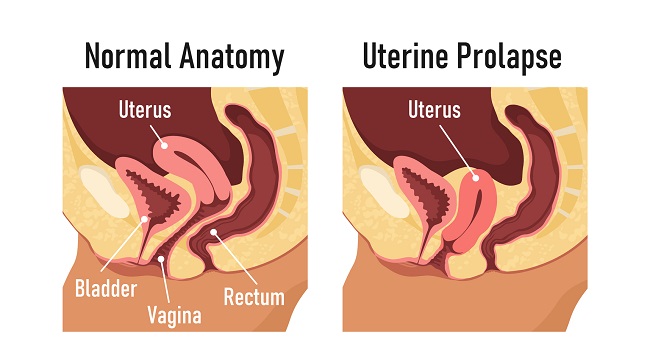 Prolapsda ahmoq Prolapsda ahmoq