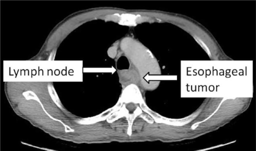 Gambar 1. CT-scan toraks menunjukkan tumor esofagus yang mengobstruksi lumen di sepertiga tengah esofagus. (Sumber: Openi, 2015)