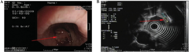 Gambar 2. (A) Endoskopi menunjukkan neoplasma esofagus (panah merah). (B) EUS menunjukkan pembesaran kelenjar getah bening multipel di luar esofagus (panah merah)