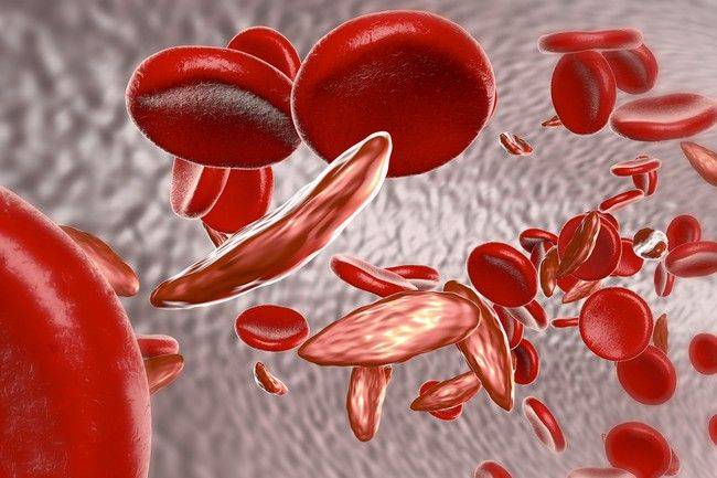 Sickle Cell Disease