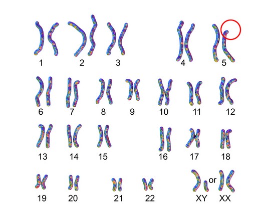 กลุ่มอาการคริดูชาต์ (Cri-du-chat Syndrome)