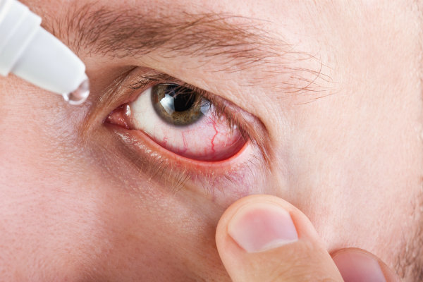Keratitis
