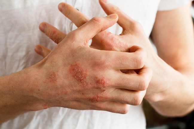 ผื่นรูปเหรียญ (Nummular Dermatitis)